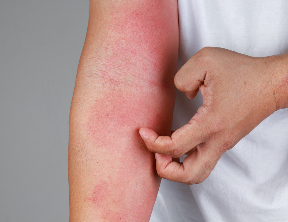 Dermatitis Atòpica: Consells Per A Combatre Els Brots De Primavera.